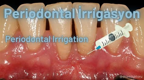 Periodontal Tedavide İrrigasyon Irrigation in Periodontal Theraphy