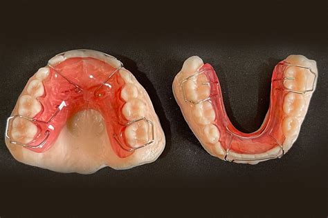 Retainers Grapevine And Coppell Tx Stellar Smiles