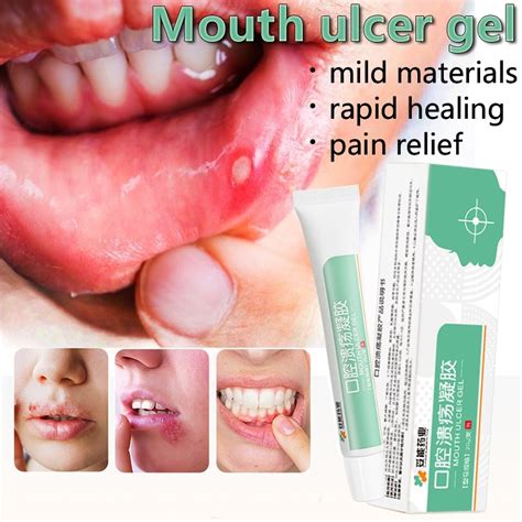 Mouth ulcer gel oral ulcer gel 20g canker sore treatment rapid recovery ...