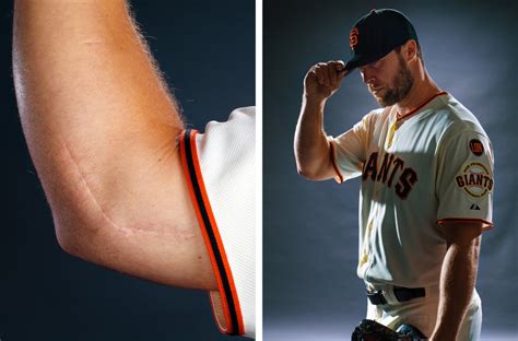 Ulnar Collateral Ligament Reconstruction Aka Tommy John Surgery Home