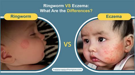 Ringworm Vs Eczema What Are The Differences Happy Cappy