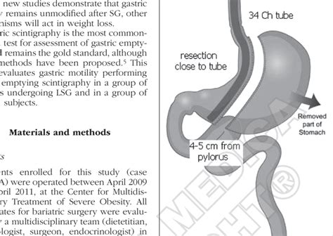 Sleeve Gastrectomy Scheme Of Standardized Procedure Download