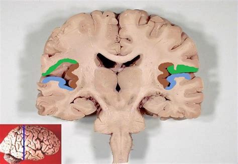 Greenparietal Operculum Blue Temporal Operculum Heschls Gyrus