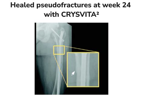 Efficacy In Adults Crysvita Burosumab Twza