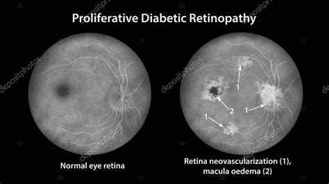 Retinopat A Diab Tica Proliferativa Ilustraci N Que Muestra