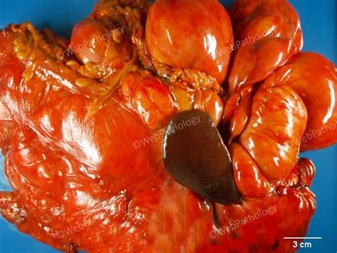 Atypical Lipomatous Tumor Well Diff Liposarcoma Gross Pathology