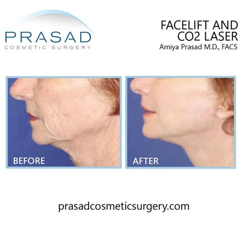 Facial Laser Treatment vs Surgical Facelift: Which is better?