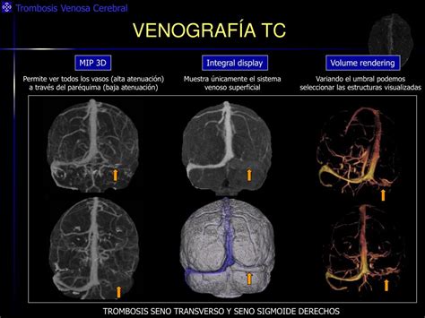 Ppt Trombosis Venosa Cerebral “ Lo Que El Radiólogo General Debe Saber ” Powerpoint