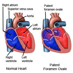 Foramen Ovale