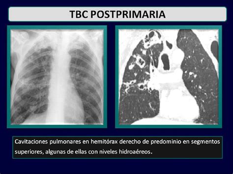 Figure From Manifestaciones Radiol Gicas De La Tuberculosis Pulmonar