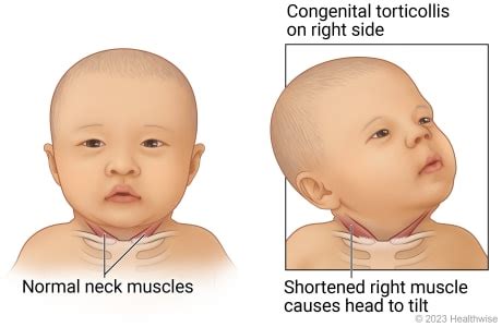 What Is Congenital Torticollis Symptoms And Treatments Commonspirit