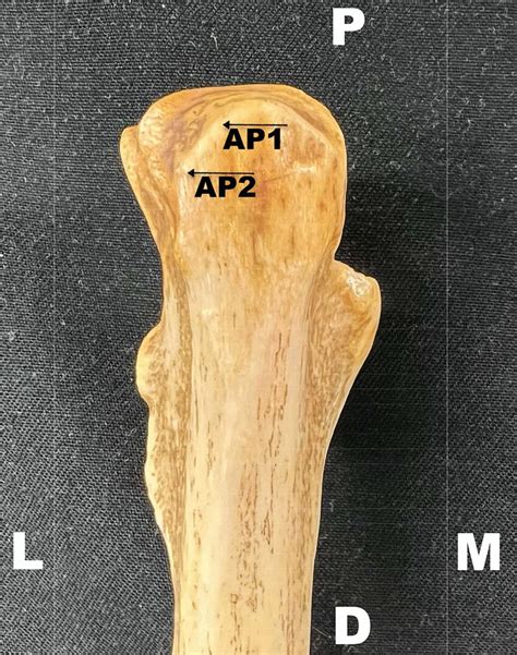 Bony Anatomical Landmarks A Proximal Ulna Is Displayed With The Two