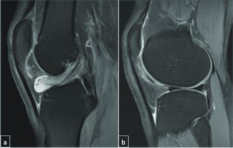 Sagittal Proton Density Fat Suppressed Images Showing ACL Ganglion A