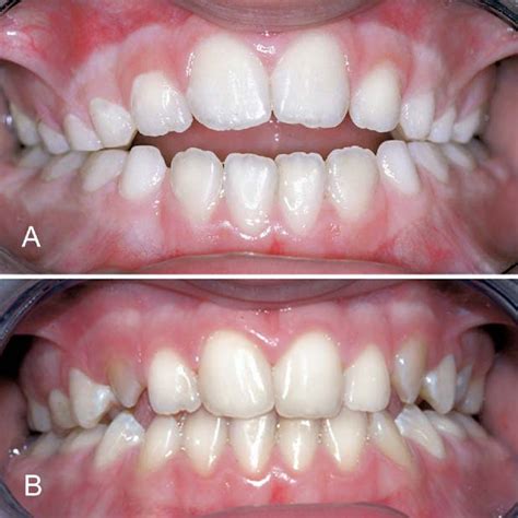 Figure From Treatment Effects Of A Modified Quad Helix In Patients