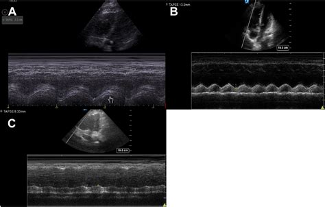 Focused Ultrasonography In Cardiac Arrest Emergency Medicine Clinics