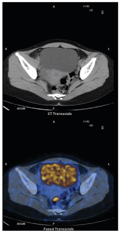 Figure 1 From Neoadjuvant Chemotherapy Followed By Conization To Spare