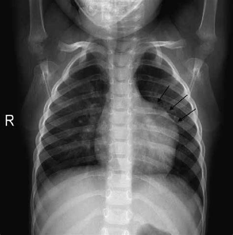 Chest Radiography Shows Enlargement Of The Left Heart Border At The Download Scientific Diagram