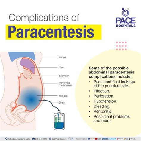 Paracentesis Ascites Tapping In Hyderabad India Indication And Cost