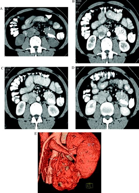 The Value Of Mdct In Diagnosis Of Hyaline Vascular Castleman S Disease