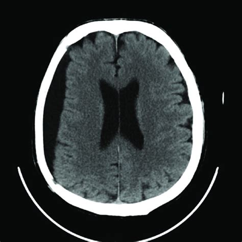 Axial Brain CT Scan Image Showing Right Hemispheric Chronic Subdural