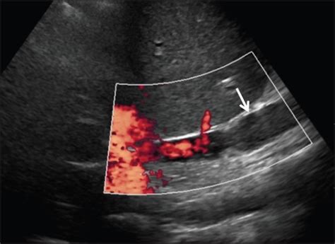 68-year-old man three months status post liver transplant with IVC clot ...