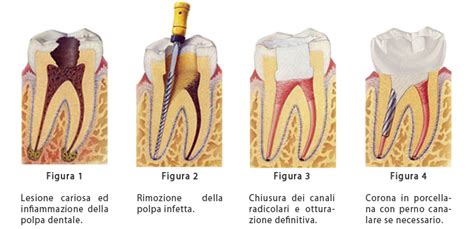 Il Trattamento Endodontico Endodonzia Cliniche Del Sorriso