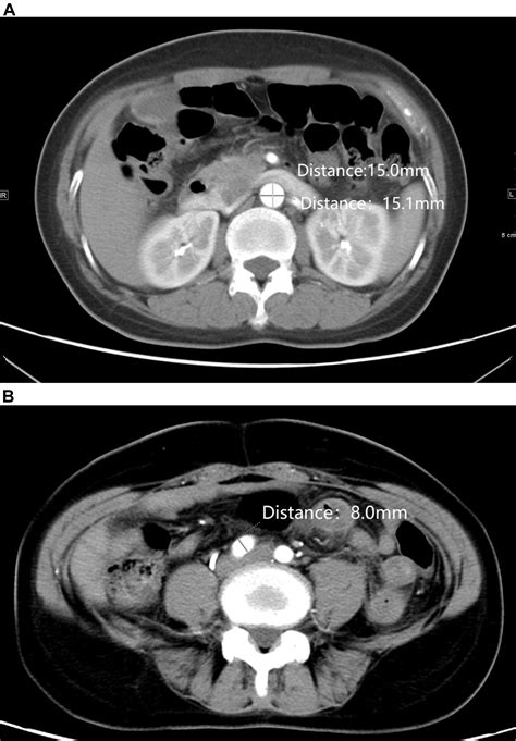 Normal Diameter And Growth Rate Of Infrarenal Aorta And Common Iliac