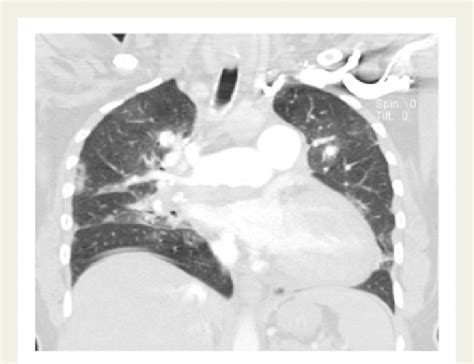 Computed Tomography Angiography CTA Of The Chest Coronal