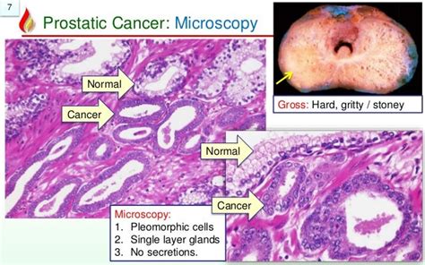 Pathology Of Prostate Cancer