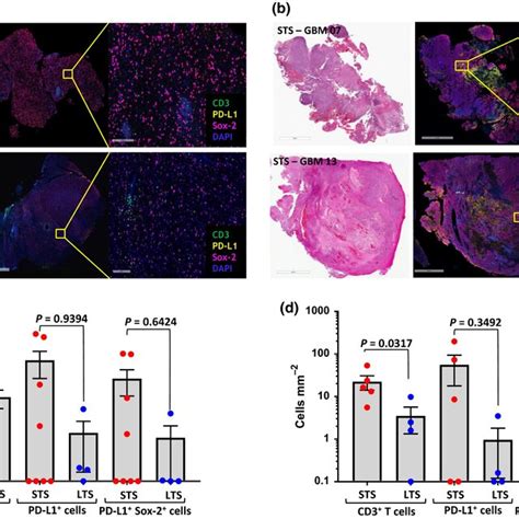 Multiplexed Immunohistochemical Analysis Of CD3 PDL1 And Sox2 In GBM