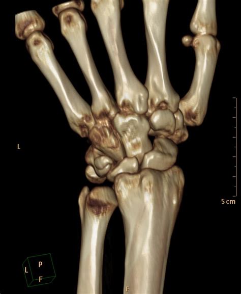 Radiopaedia case Triquetral fracture id: 52227 study: 58109 - NC Commons