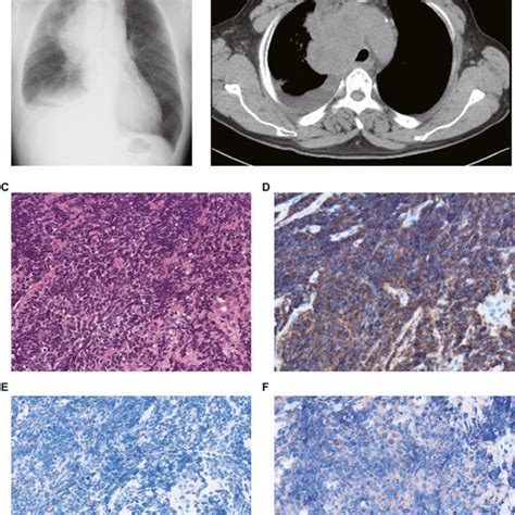 Chest X Ray A And Computed Tomography B Showed A Large Mass With