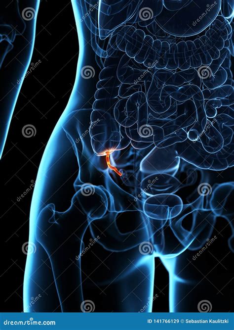 Inflamed Appendix Appendicitis Digestive System Vector Illustration