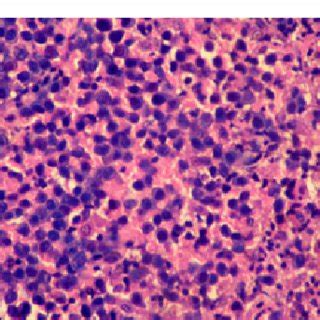 Photomicrograph Of Histopathological Analysis Of Excisional Biopsy