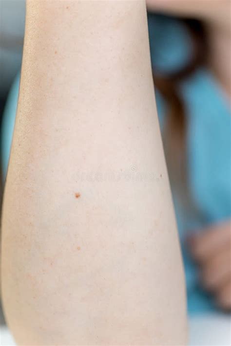 A Birthmark Or A Mole On A Woman Skin Stock Photo Image Of Woman