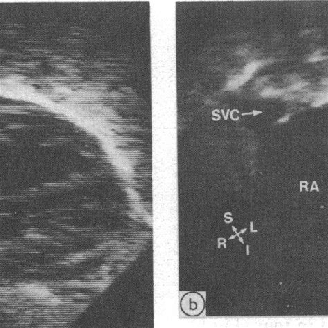 Cross Sectional Echocardiograms Showing Total Anomalous Pulmonary