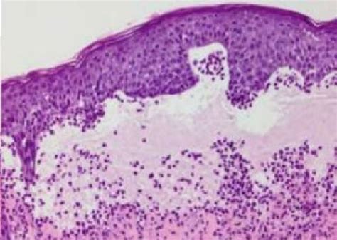 A Photomicrograph Of Linear IgA Bullous Dermatosis Showing A