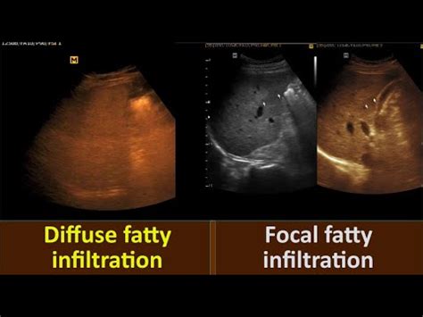 Fatty Liver Grade Three Diffuse Fatty Infiltration Focal Fatty