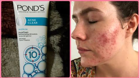 Ponds Acne Clear Face Wash Honest Reviewbest Face Wash For Oily And Acne Skin Youtube