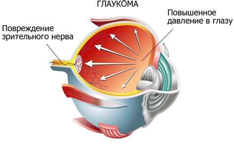 Признаки глаукомы и катаракты - симптомы и методы лечения