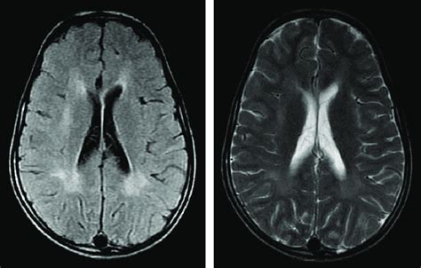 Periventricular White Matter Abnormalities Gliosis Axial Flair Tr Download Scientific