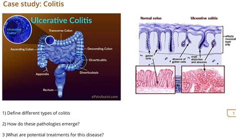 SOLVED: Case Study: Colitis Ulcerative Colitis Normal Colon Ulcerative ...