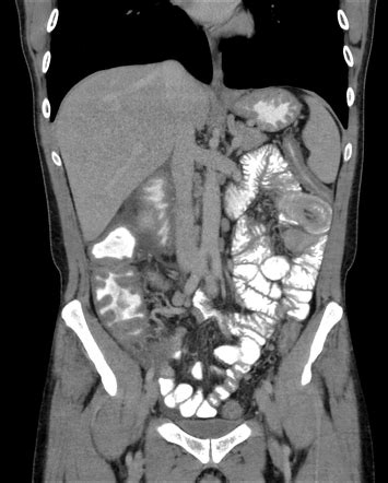 Ulcerative Colitis Radiology Reference Article Radiopaedia Org