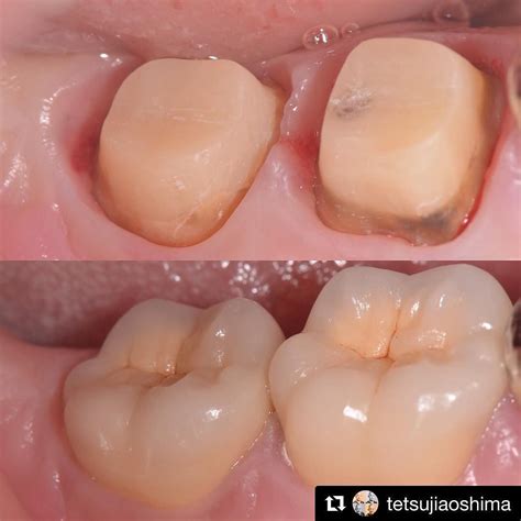 Tratamientos Dentales Restorative Dentistry Dental Crowns Happy Dental