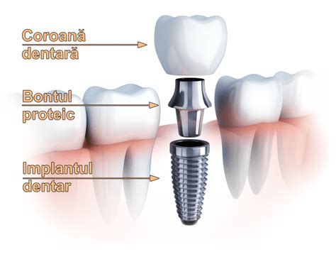 C T Cost Un Implant Dentar