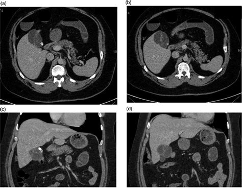 Rare Presentation Of Gallbladder Schistosomiasis A Case Report Yahia