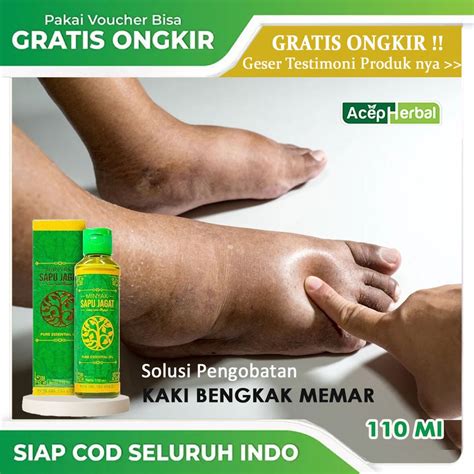 Jual Obat Alami Kaki Bengkak Obat Oles Untuk Kaki Bengkak Obat