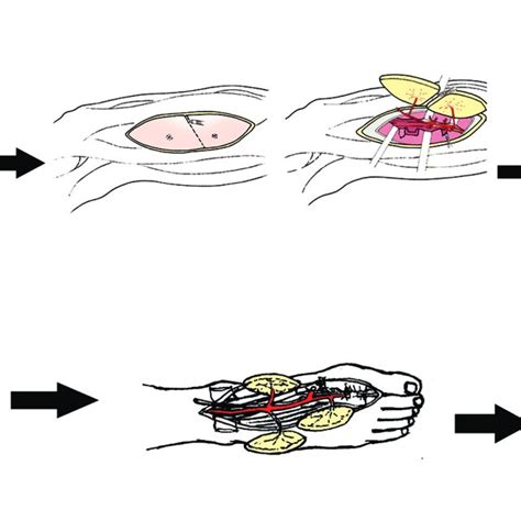 The Chimeric Dpa Flaps For Reconstructing Distal Palmar Hand And Palmar