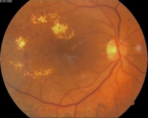 [figure Diabetic Macular Edema Contribution By ] Statpearls Ncbi Bookshelf