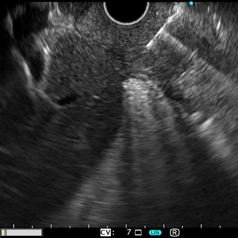 Endoscopic ultrasound fine-needle biopsy of the thickened duodenal wall. | Download Scientific ...